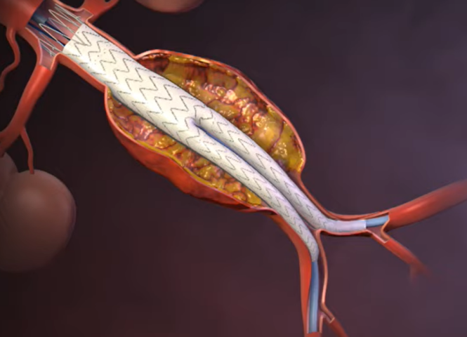 Endovascular Treatment