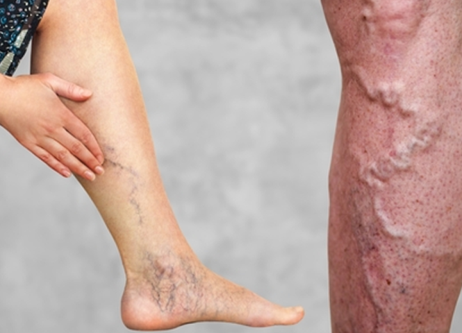 Venous Insufficiency Surgery