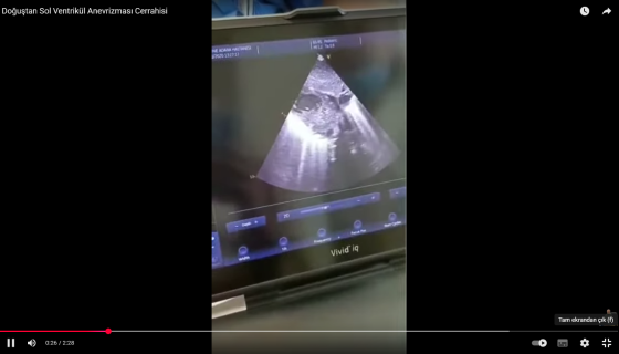 Congenital Left Ventricular Aneurysm Surgery